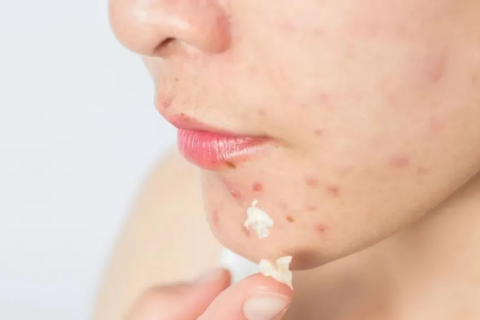 Saúde: “Acne” Saiba como prevenir e conheça os principais tratamentos